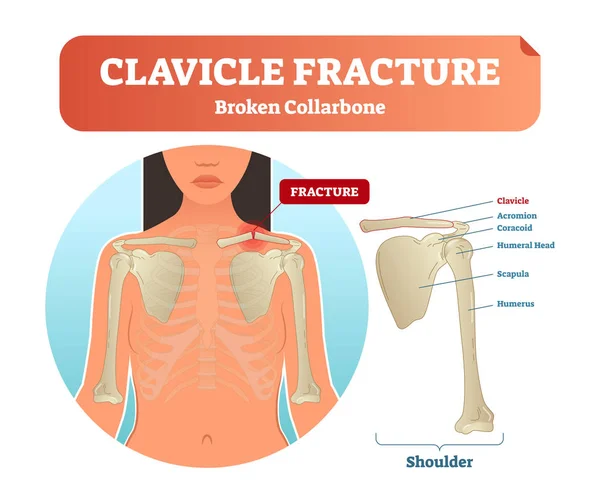 Fractura de clavícula con ilustración vectorial de clavícula rota. Esquema médico y anatómico etiquetado con fractura de clavícula, acromion, cabeza humeral, escápula y húmero . — Vector de stock