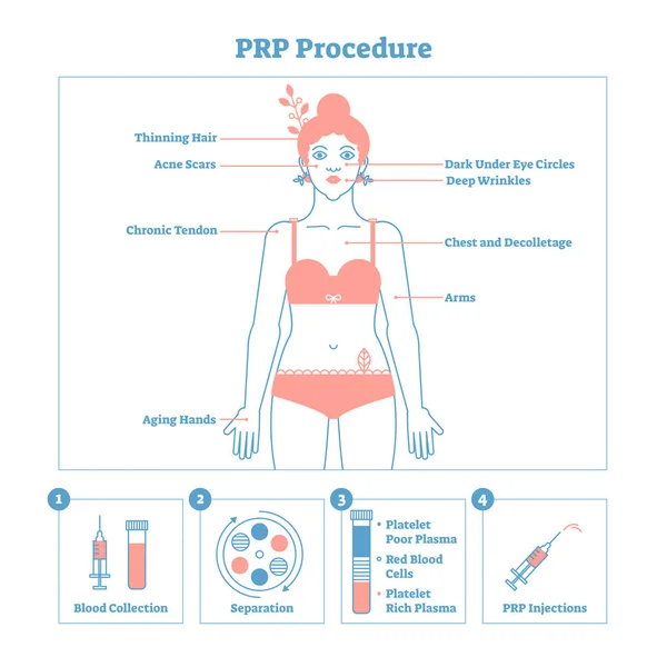 PRP Diagrama gráfico da ilustração do vetor do procedimento, esquema do procedimento do cosmetology. Mulheres beleza e cuidados com a pele. Cartaz de design limpo estilo linha com etiquetas . —  Vetores de Stock