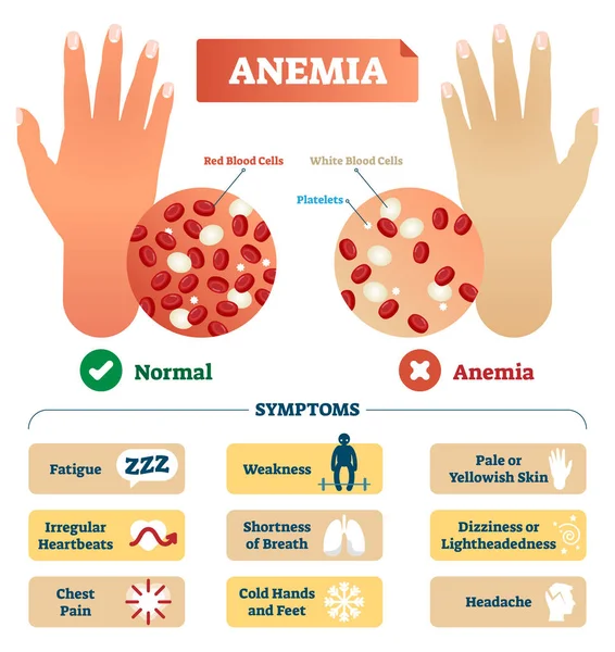 Ilustración del vector de anemia. Esquema etiquetado con glóbulos rojos . — Vector de stock