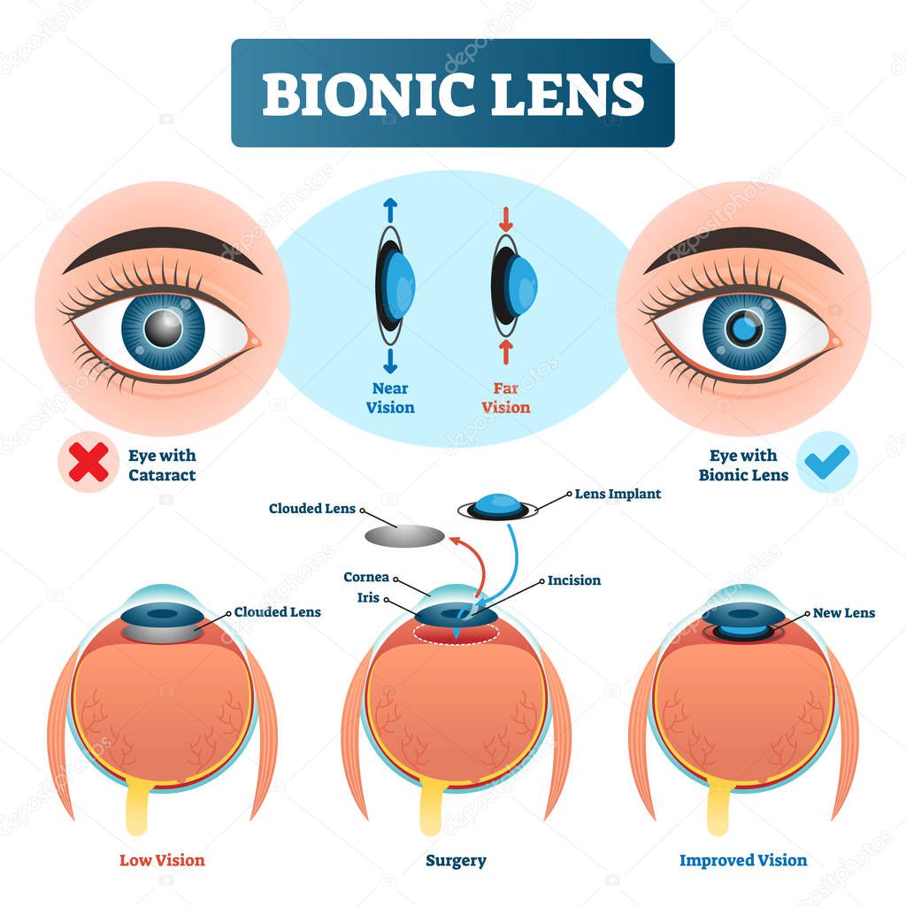 Bionic lens vector illustration. Eye lens structure labeled scheme.