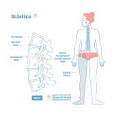 Картина, постер, плакат, фотообои "sciatica medical health care vector illustration diagram scheme with lower spine and sciatic nerve pain in leg.", артикул 211825348