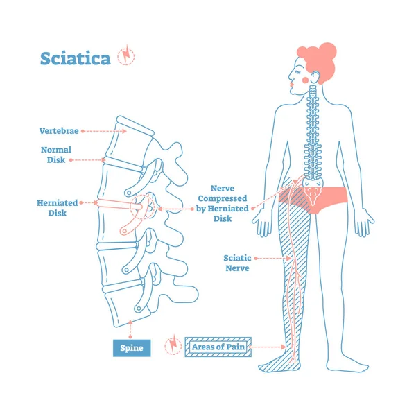 Esquema de ilustração do vetor de cuidados médicos Sciatica com coluna inferior e dor no nervo ciático na perna . —  Vetores de Stock