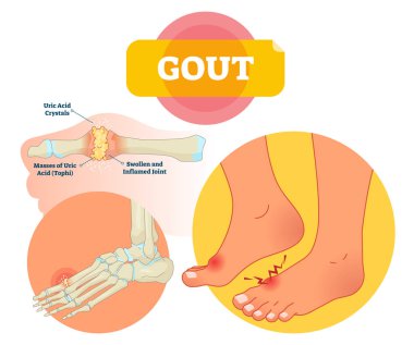 Gout vector illustration. Swollen and inflamed joint labeled scheme. clipart
