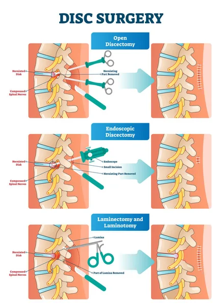 Ilustración vectorial de cirugía discal. Diagrama con dolor en los nervios y huesos de la espalda . — Vector de stock