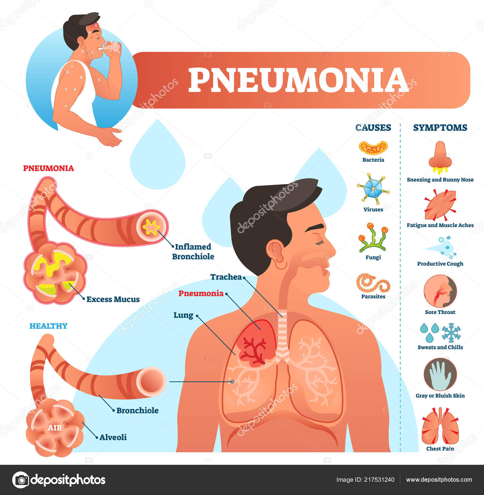 Keuhkokuumeen vektorikuvaus. Merkitty kaavio syyt ja oireet