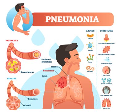 Pneumonia vector illustration. Labeled diagram with causes and symptoms. clipart