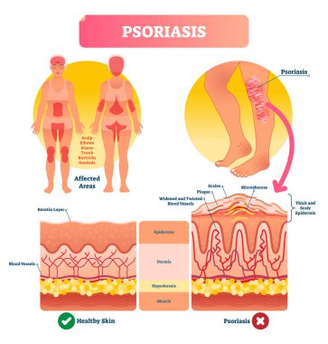 Psoriasis vector illustration. Skin disease and illness. Labeled structure. clipart
