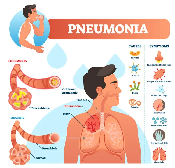 Illustrazione vettoriale della polmonite. Schema etichettato con cause e sintomi . — Vettoriale Stock