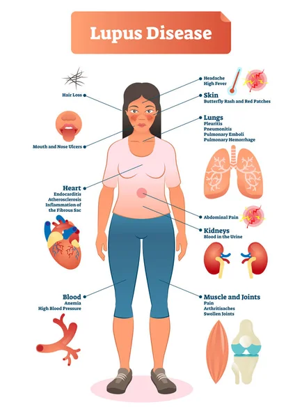 Lupus disease vector illustration. Labeled diagram with sickness symptoms. — Stock Illustration Lupus disease vector illustration. Labeled diagram with sickness symptoms. Stock Vector
