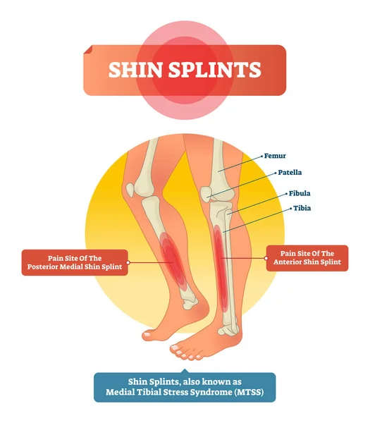 Shin Νάρθηκες διανυσματικά εικονογράφηση. Πόδι μυϊκή αθλητισμό τραύμα και οστικού πόνου. — Διανυσματικό Αρχείο