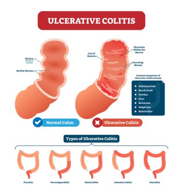 Ulcerative colitis vector illustration. Labeled anatomical infographic clipart