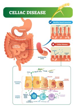 Celiac disease vector illustration. Labeled diagram with its structure clipart
