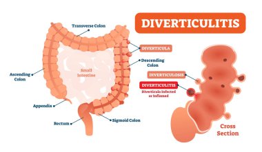 Diverticulitis vector illustration. Labeled diagram with its structure clipart
