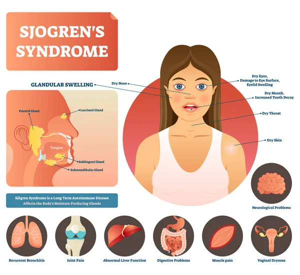 Síndrome de Sjogrens ilustración vectorial. Enfermedad autoinmune corporal seca . — Vector de stock