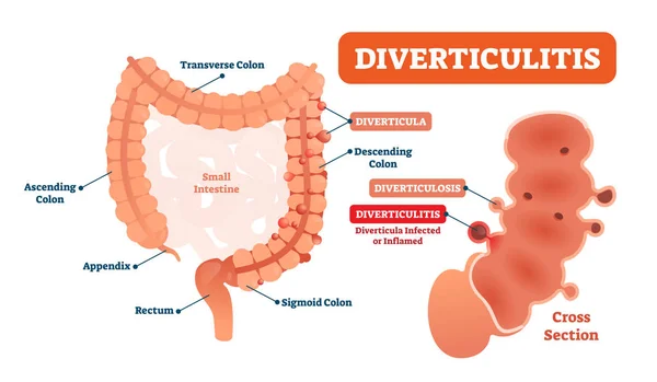 Diverticulitis vector illustration. Labeled diagram with its structure — Stock Vector