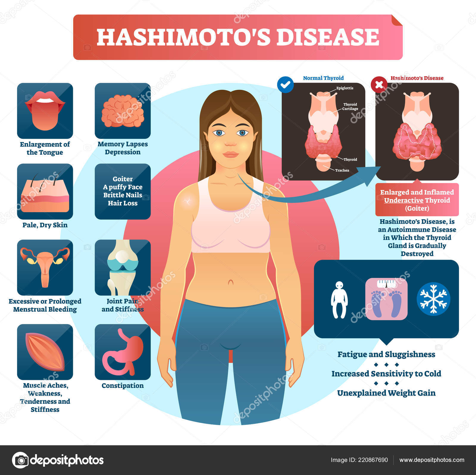 Hashimotos Tiroidite Ilustra o Vetorial Diagrama M dico Rotulado hashimotos-tiroidite-ilustra-o-vetorial-diagrama-m-dico-rotulado
