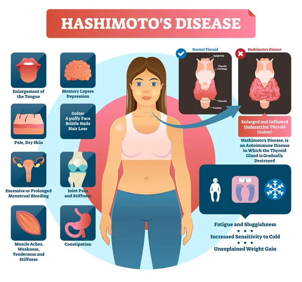 Illustration vectorielle de Hashimotos thyroiditis. Diagramme médical étiqueté . — Image vectorielle