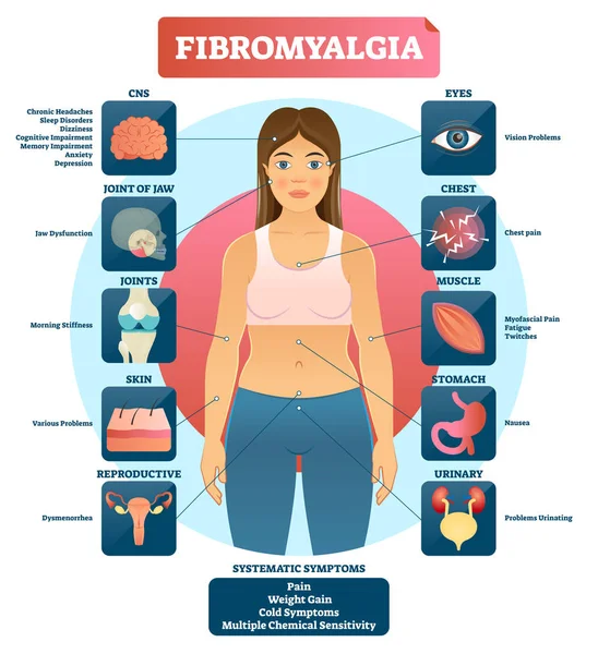 Fibromyalgie vektorové ilustrace. Diagnóza příznaky s označením diagramu. — Stockový vektor