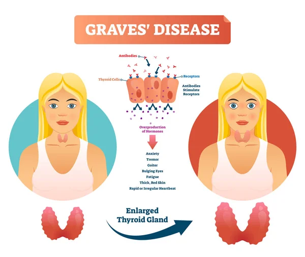 Graves enfermedad vector ilustración. Diagrama de síntomas de diagnóstico etiquetados — Archivo Imágenes Vectoriales