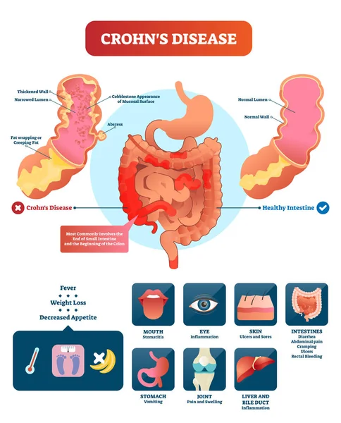 Crohns enfermedad vector ilustración. Diagrama etiquetado con diagnóstico . — Vector de stock