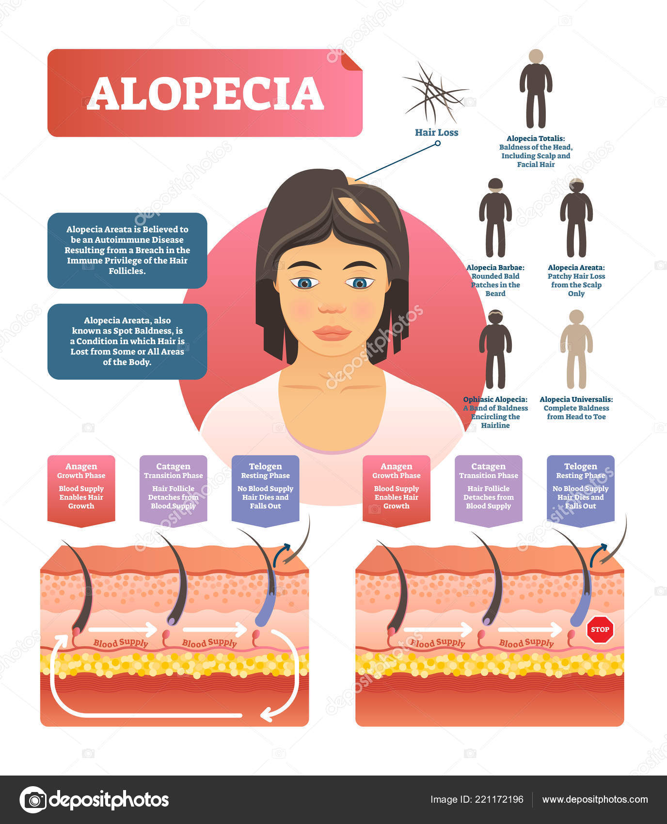 Alopecia - hair loss autoimmune disease medical vector diagram illustration  Stock Vector Image by ©VectorMine #221172196