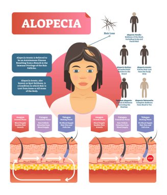 Alopecia - hair loss autoimmune disease medical vector diagram illustration clipart