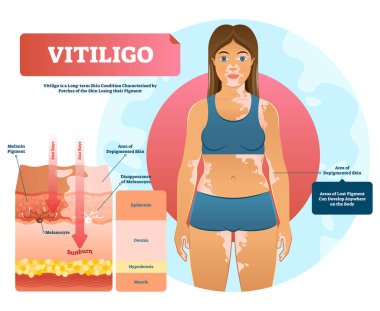 Vitiligo vektör çizim. Beyaz pigment otoimmün hastalığı pigment kaybı ile.