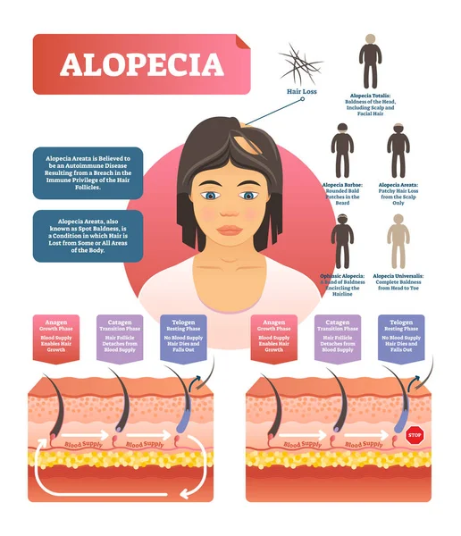 Αλωπεκία - μαλλιά απώλεια αυτοάνοση ασθένεια ιατρική διανυσματικό διάγραμμα εικονογράφηση — Διανυσματικό Αρχείο