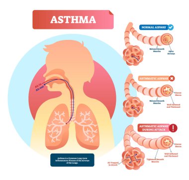 Asthma vector illustration. Disease with breathing problems diagram.. clipart