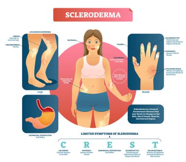 Skleroderma vektör çizim. Otoimmün cilt ve kan hastalığı.
