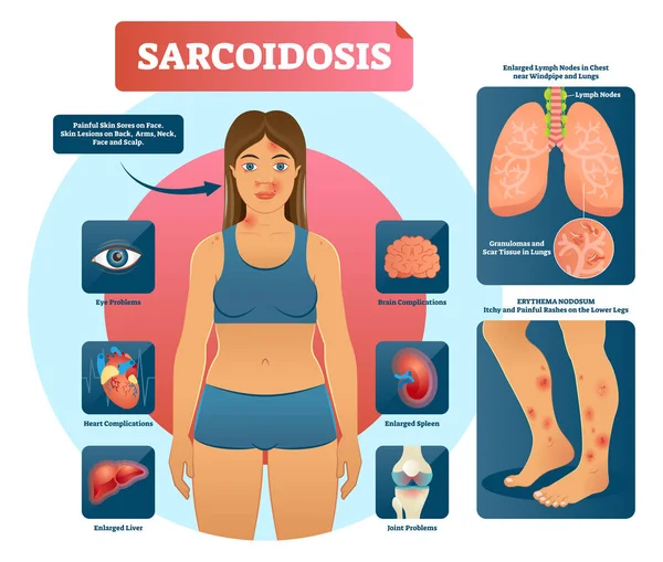 Sarcoidosis vektoros illusztráció. Tüdő, a szív, a szem autoimmun betegség — Stock Vector