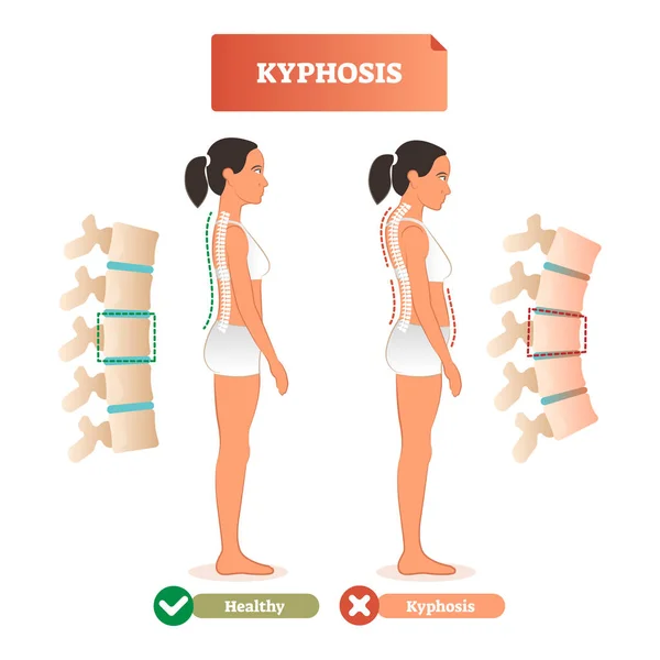 Ilustração vetorial da cifose. Diagnóstico de defeito da coluna vertebral nas costas vs saudável . —  Vetores de Stock