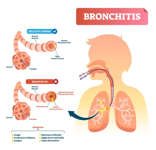 Ilustração do vetor da bronquite. Diagnóstico de doença pulmonar com sintomas . — Vetor de Stock