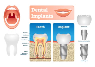Diş implantları illüstrasyon vektör. Etiketli sağlık scheme diş kapak.