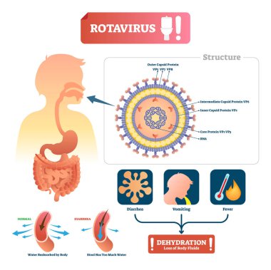 Rotavirüs vektör çizim. Mide tıbbi hastalığı belirti ile etiketlenmiş