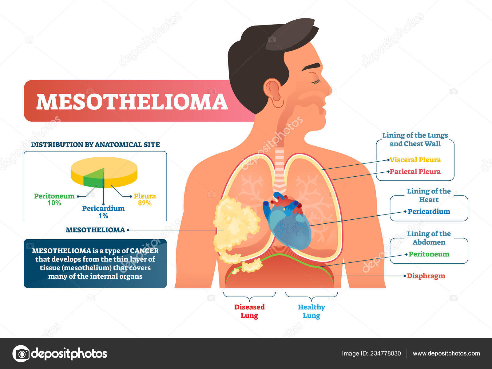 Mesothelioma Vector Illustration Labeled Lung Cancer Educational Scheme Stock Vector Image By C Vectormine 234778830