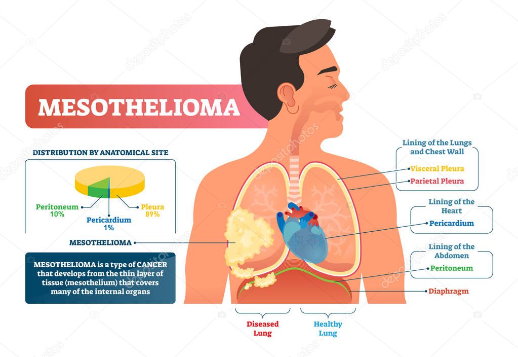 Mesothelioma vector illustration. Labeled lung cancer educational scheme.