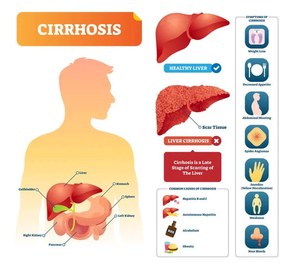 Ilustrasi vektor Cirrhosis. Diagram medis berlabel dengan gejala penyakit - Stok Vektor