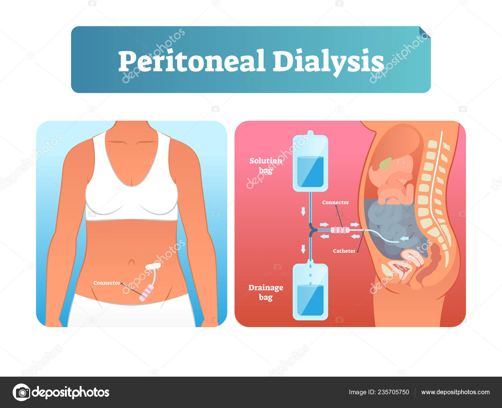 Peritoneal dialysis vector illustration. Labeled method to exchange fluids.  Stock Vector Image by ©VectorMine #235705750