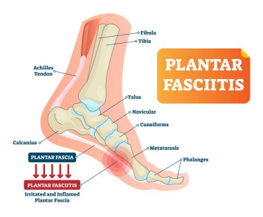 Plantar fasiit illüstrasyon vektör. Etiketli insan ayak bozukluğu diyagramı.