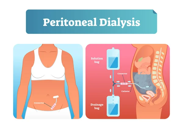 Ilustração do vetor de diálise peritoneal. Método rotulado para troca de fluidos . — Vetor de Stock