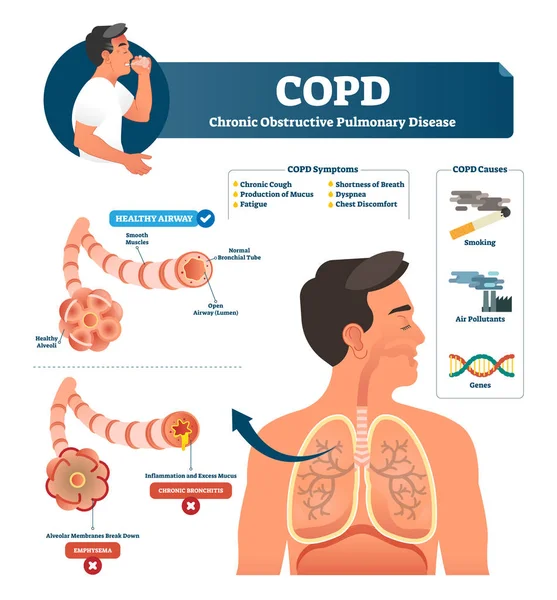 Illustration vectorielle de BPCO. Étiqueté explication pulmonaire obstructive chronique — Image vectorielle