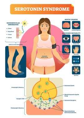 Serotonin syndrome vector illustration with medical labeled symptoms scheme clipart