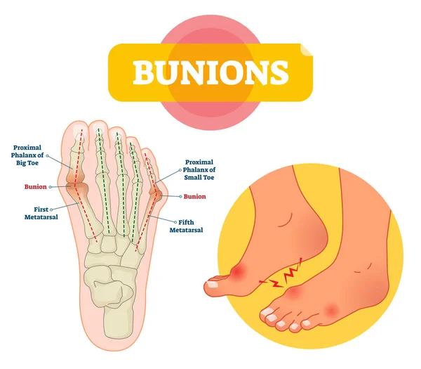 Ilustración vectorial juanetes. Esquema de explicación del trastorno óseo pies etiquetados . — Vector de stock