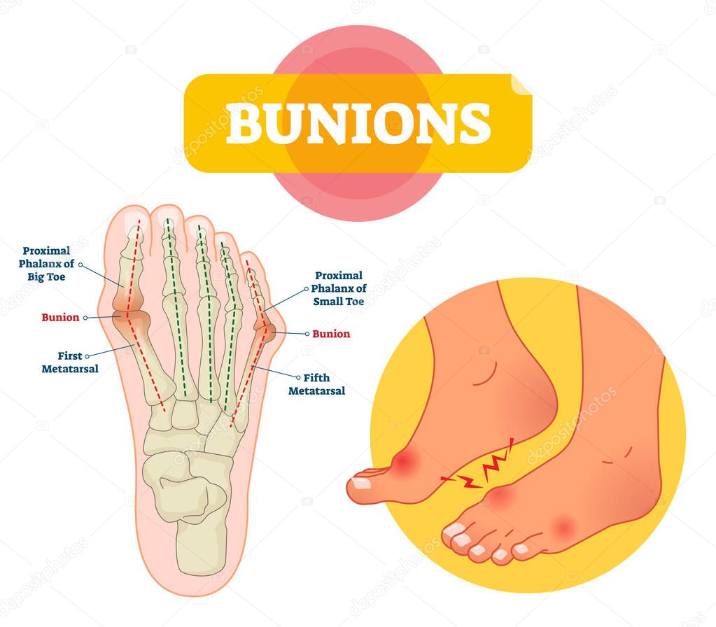 Bunions vector illustration. Labeled feet bone disorder explanation scheme.
