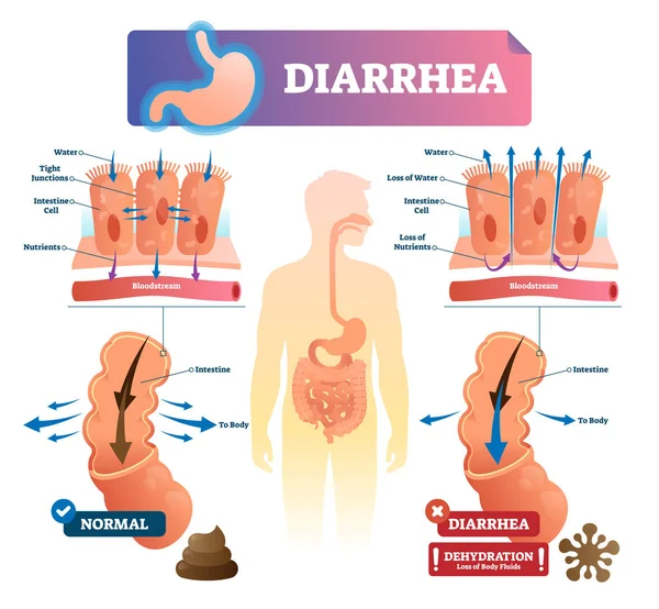 Diarrhea vector illustration. Labeled stomach gut illness medical scheme. — Stock Illustration Diarrhea vector illustration. Labeled stomach gut illness medical scheme. Royalty Free Stock Illustrations