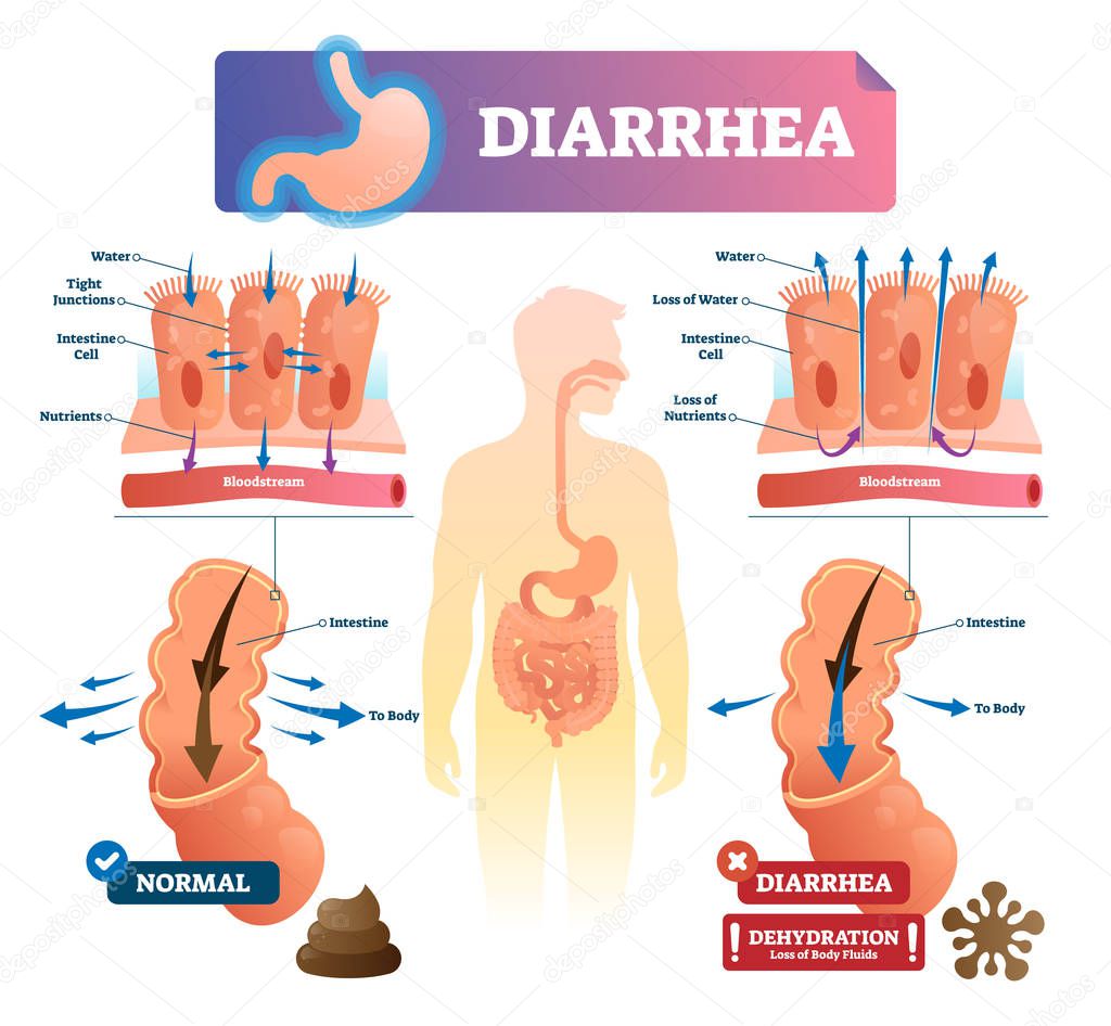 Diarrhea vector illustration. Labeled stomach gut illness medical scheme.