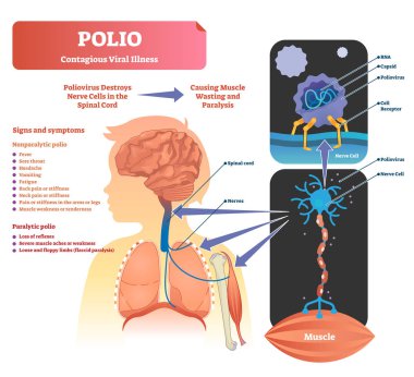 Polio vector illustration. Labeled medical virus infection symptoms scheme. clipart