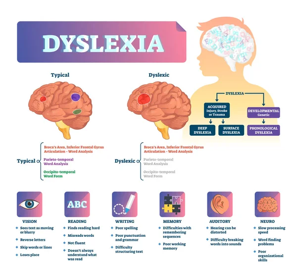 Ilustracja wektorowa dysleksji. System problem choroba mózgu medyczne oznaczone. — Wektor stockowy