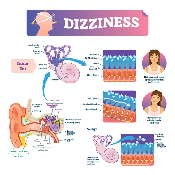 Dizziness vector illustration. Labeled scheme with inner ear and vertigo. — Stock Vector